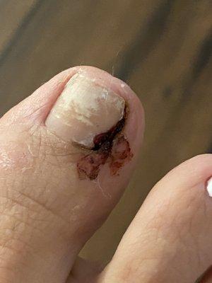 Injured toe