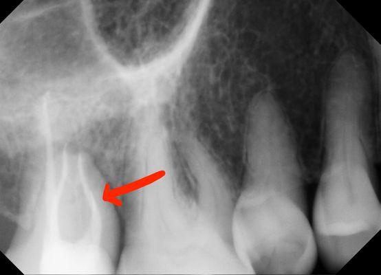 Dentist left broken instrument in tooth. Failed to disclose complication to patient.