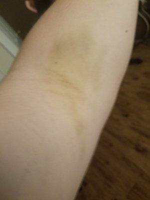 Massive painful bruise from a botched IV 5 days later.