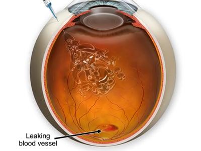 Retina Vitreous Associates of Florida