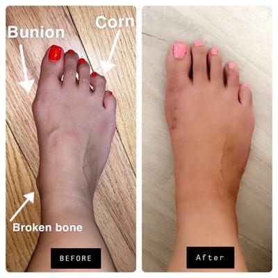 Before and After foot surgery