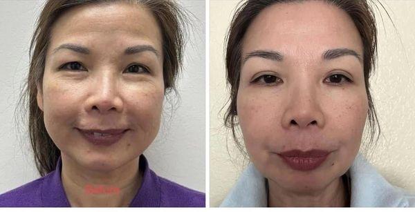 Before/1-week after 1st Tempsure treatment