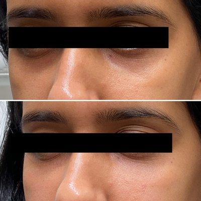 Tear trough (lower eyelid) treatment with filler