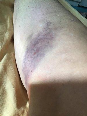 Hematoma on right inner thigh from assault in
 "310 laundromat"