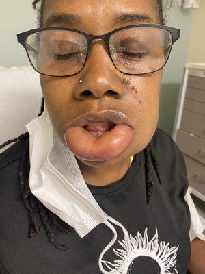 Swollen lip and jaw area