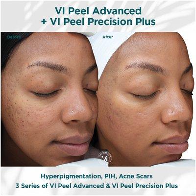 VI PEEL 
Hyperpigmentation, Acne