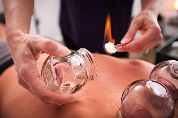 Fire cupping