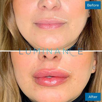 Another day, another perfect pout! This patient already had beautiful lips to begin with, but she wanted a slight enhancement.