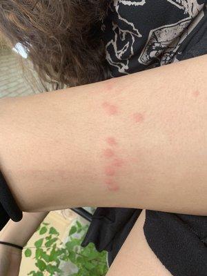 Bed bugs bit my daughter