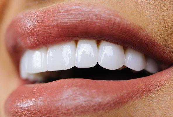 Porcelain veneers were used to transform this smile.