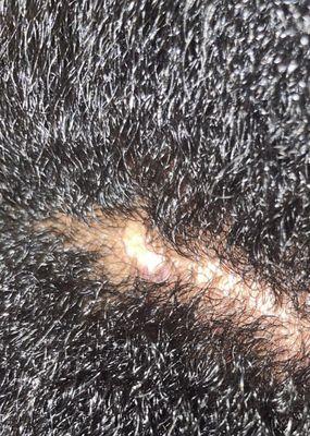 Possible infected scalp lesion