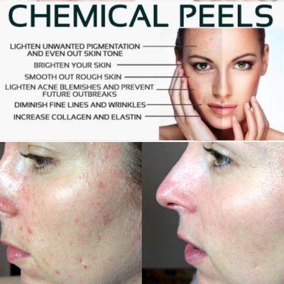 want better skin? Chemical peels are what your skin ordered...