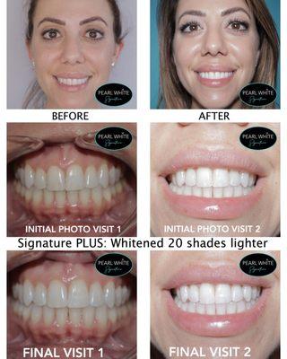 Signature PLUS Laser Teeth Whitening. Removing stain while limiting sensitivity is our specialty!