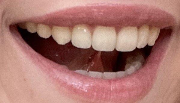 My teeth after treatment