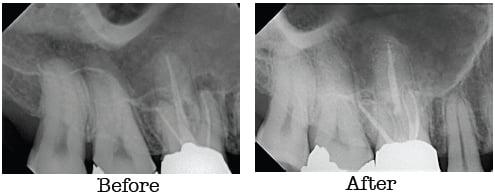 Dark area on root tip disappeared after root canal retreatment.