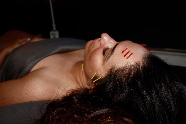 Acupuncture Facial