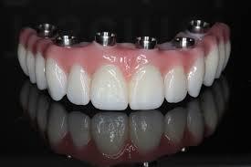 Prettau zirconia implant bridge