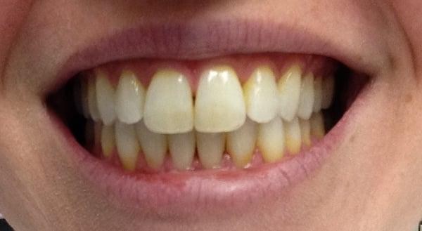 Before Whitening