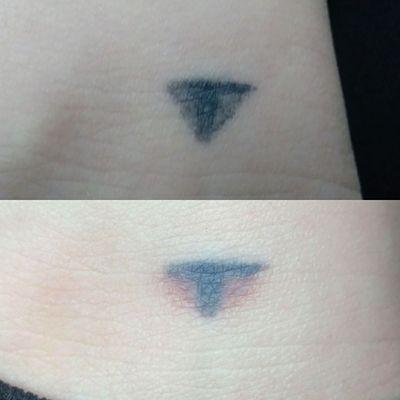 Tattoo revision. Removal of a small area to fix the shape of this tattoo.