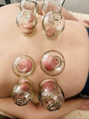 Cupping