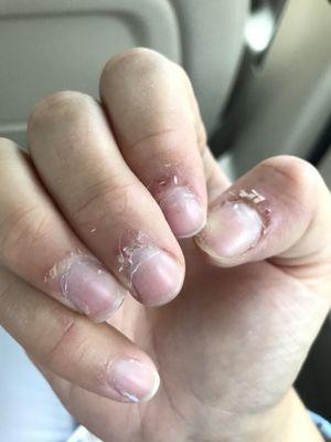 Cuticles were ruined due to an awful manicure.