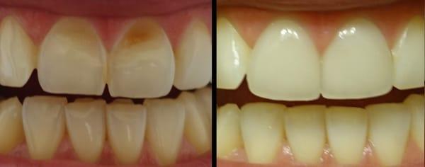 Before and after getting porcelain veneers on my front two teeth