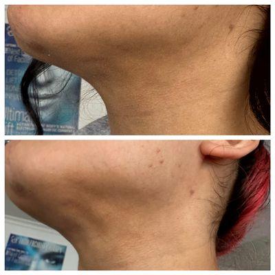 Chin lipo fibrosis treatment