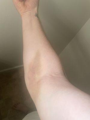 Terrible bruise. Never had anything this bad from a blood draw.