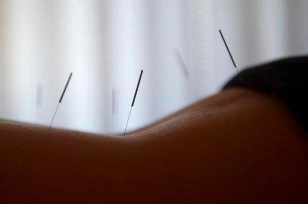 Acupuncture on lower back