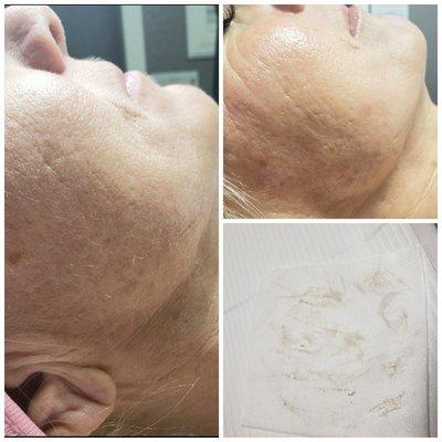 A before and after of a dermaplaning facial.