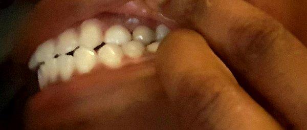 Take a guess which implant was put incorrectly & made way brighterthan my own teeth?