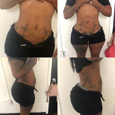 Post operative/lymphatic treatment was performed for these amazing results. Lymphatic treatments are essential healing after lipo.