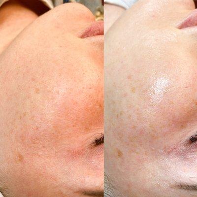 Dermaplaning