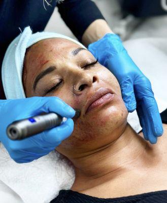 Microneedling