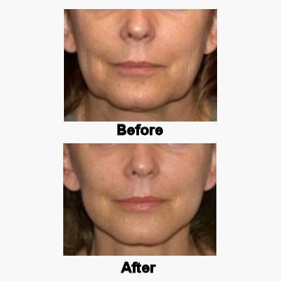 Botox & thread lift for neck lift and jaw line definition