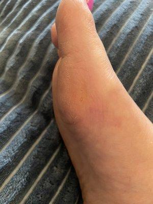 Callouses and dry skin