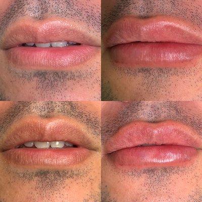 Lip augmentation