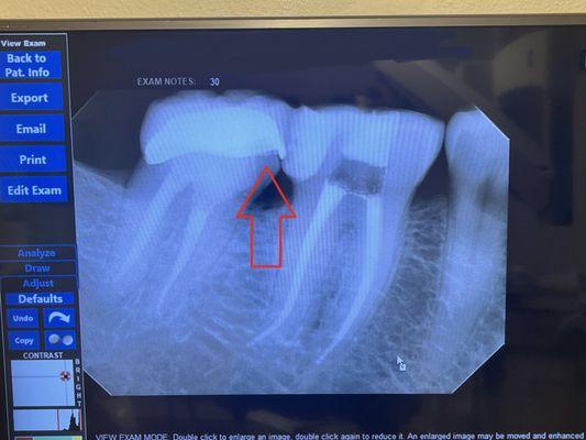 X-ray showing, how delete dental groups put in the crown with a cap below, it allowing bacteria under it