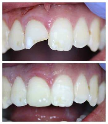 Our patient broke tooth playing basketball in the morning. Same day filling in the evening