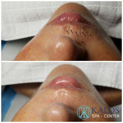 Wrinkles around lips treatment