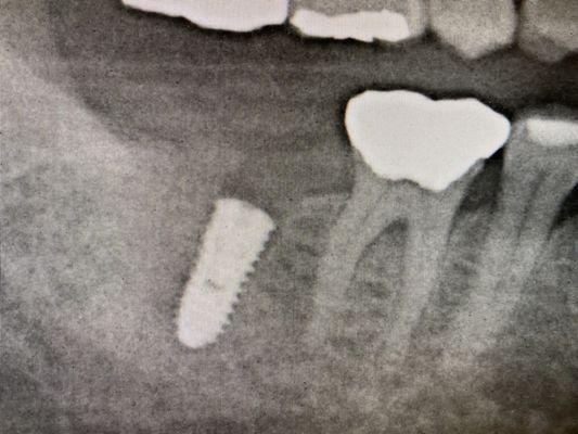 First stage of implant surgery