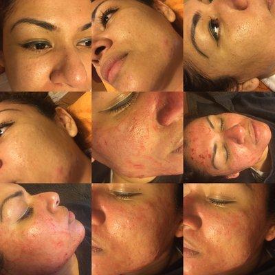 Microneedling