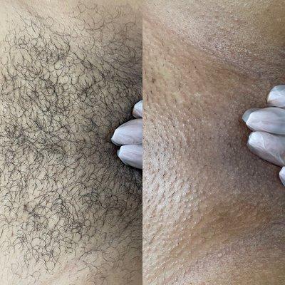 Before and after Brazilian wax