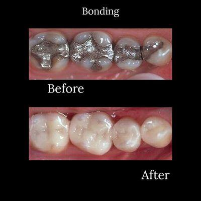 Changing old fillings