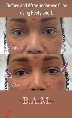 Before & After under eye filler