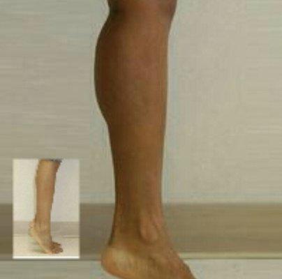 Calf augmentation using silicone implants