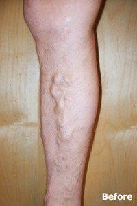 Patient 6 - varicose vein treatment BEFORE