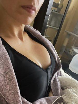 Breast augmentation 415cc