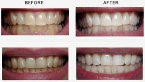 We offer teeth whitening