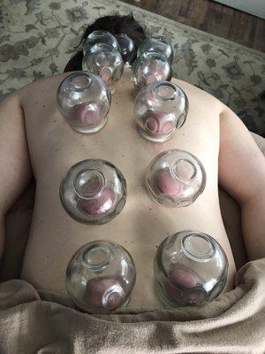 Glass Cupping Therapy